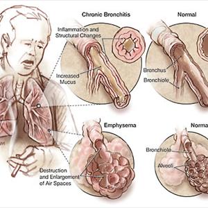 Bronchitis Herbal Remedies - Pneumonia - Causes, Signs And Also Treatment
