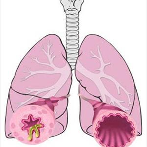 Bronchitis Lasts Forever - Bronchitis Diagnosis