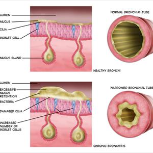 About Bronchitis - Lung Cleansing For Smokers To Avoid A Tacky Fate