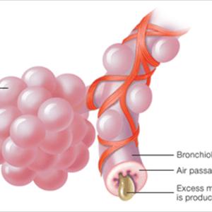 Coughs And Bronchitis - Bronchitis Education - A Brief Explanation From The Disease