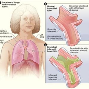 Inhaler Cures For Chronic Bronchitis - Acute Bronchitis Symptoms: Cough, Fever, Chest Pain, & More