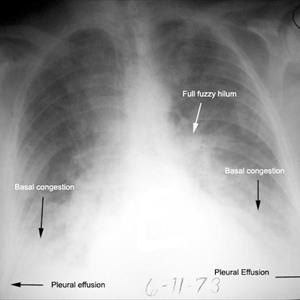 Stopping Bronchitis Coughing - Popcorn Lung