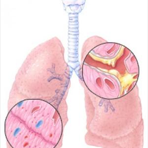 Bronchial Infection Symptoms Remedies - COPD - The Easiest Way Manage Serious Obstructive Lung Sickness