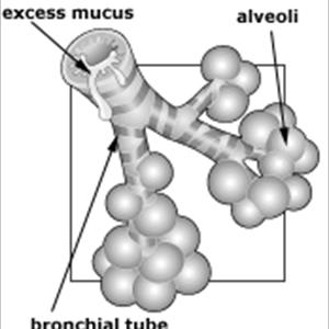 Bronchitis And Smoking - Bronchitis Duration