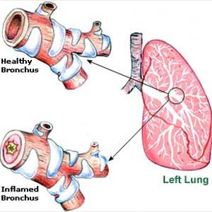 Prolonged Bronchitis Cough - Herbal Fix For Cough