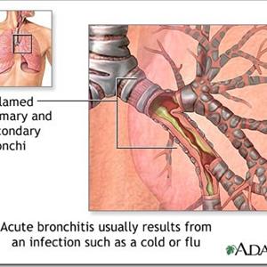 Acute Bronchitis With Asthmatic Component - Acute Bronchitis - Causes, Symptoms And Treatment Options