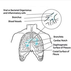 Bromovil - Bronchitis Signs - The Way To Recognize All Of Them For Early Diagnosis