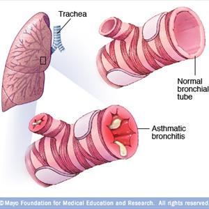 Alternative Bronchitas Cures - Types Of Lung Cancer