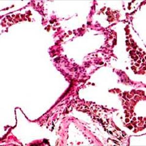 Acute Bronchitis With Asthmatic Component - Acute Bronchitis - Brings About, Symptoms And Treatment Options