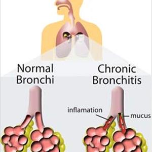 Bronchitis Doctor - Bronchitis And Also Asthma